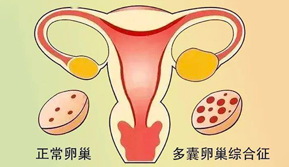 多囊卵巢综合征患者个体化辅助生殖助孕策略与难点