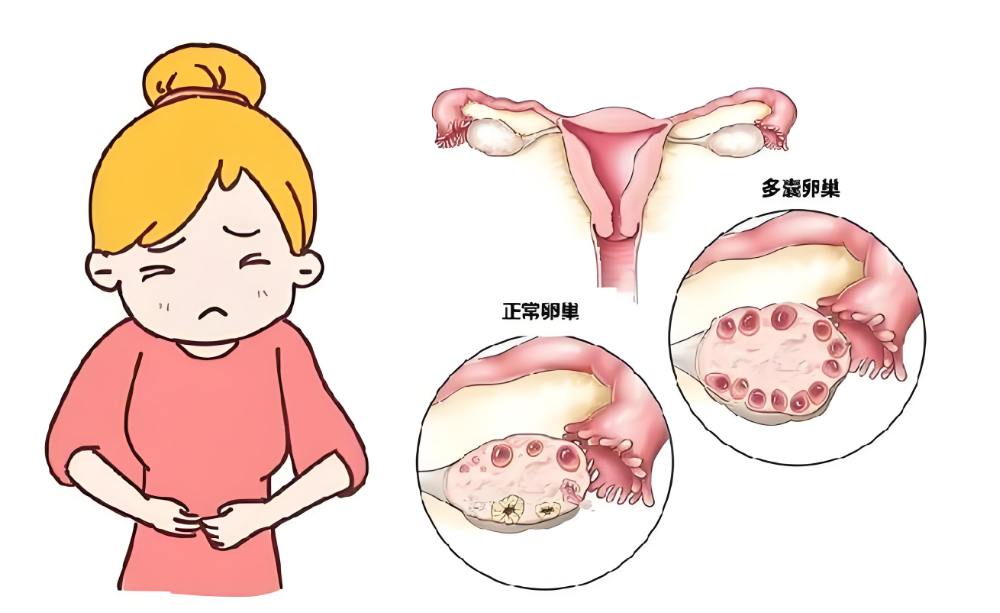  413例 多囊卵巢综合征PCOS 脂代谢异常病例分析