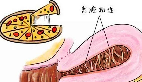 雌孕激素序贯疗法联合宫腔镜下宫腔粘连分离术治疗宫腔粘连的效果