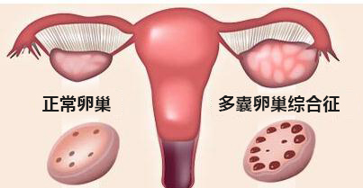 多囊卵巢综合征的发病情况、典型症状、治疗方式有哪些？