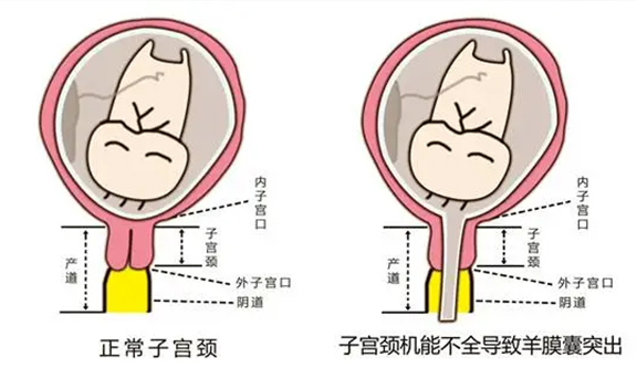 子宫颈机能不全的可能病因