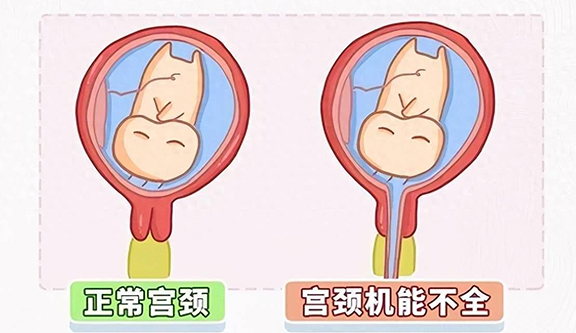 子宫颈机能不全临床诊治中国专家共识（2023年版）