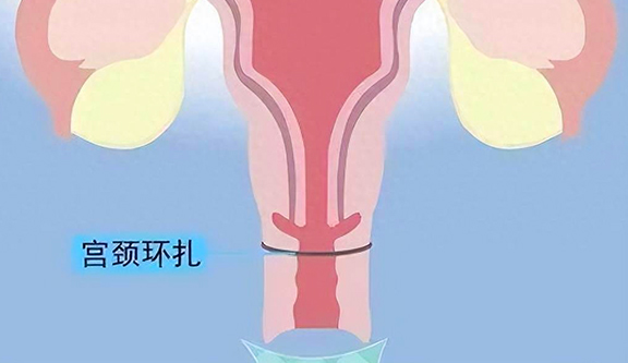 非紧急子宫颈环扎术在宫颈机能不全中的应用进展